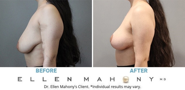 Before and After Image: Case #12366 - left-side