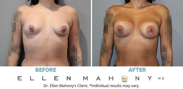 Before and After Image: Case #12388 - front