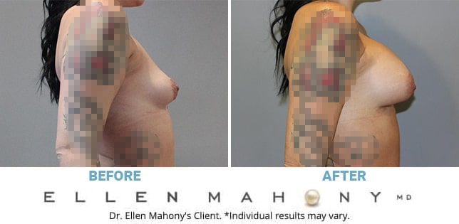 Before and After Image: Case #12388 - right-side