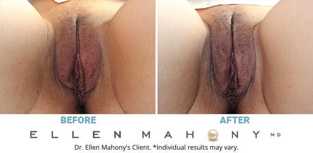 Before and After Image: Case #10958 - front