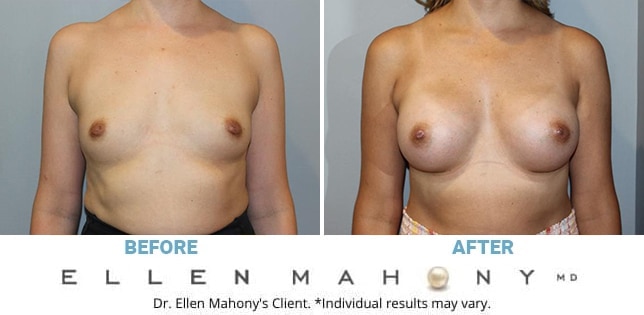 Before and After Image: Case #12004 - front
