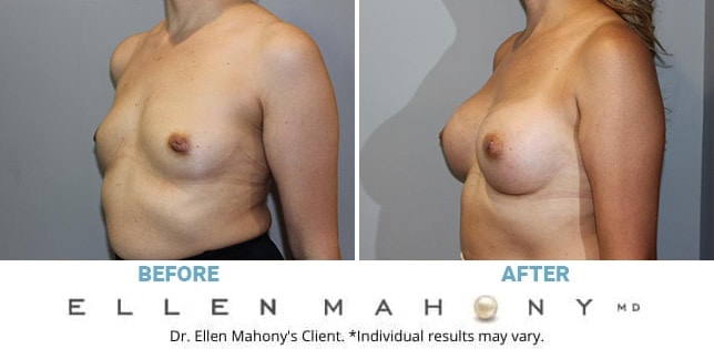 Before and After Image: Case #12004 - left-front-oblique