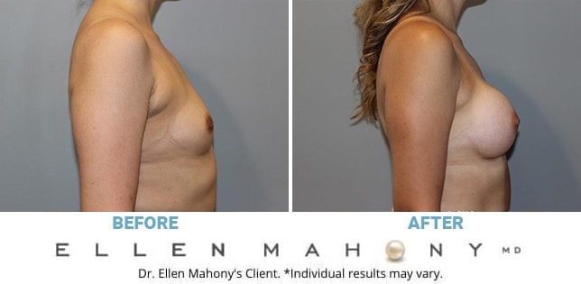 Before and After Image: Case #12004 - right-side