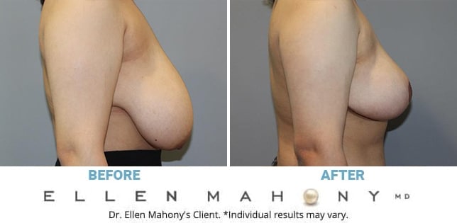 Before and After Image: Case #12296 - right-side