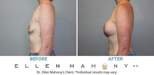 Before and After Image: Case #12672 - left-side