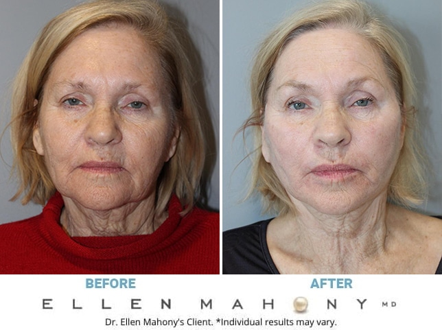 Before and After Image: Case #11998 - front