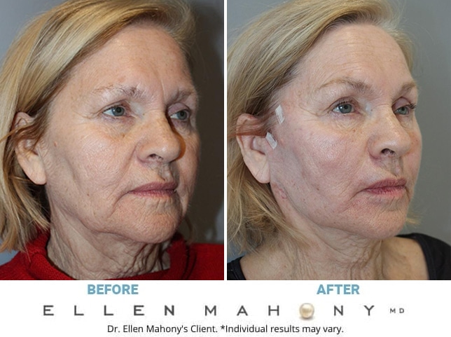 Before and After Image: Case #11998 - right-front-oblique
