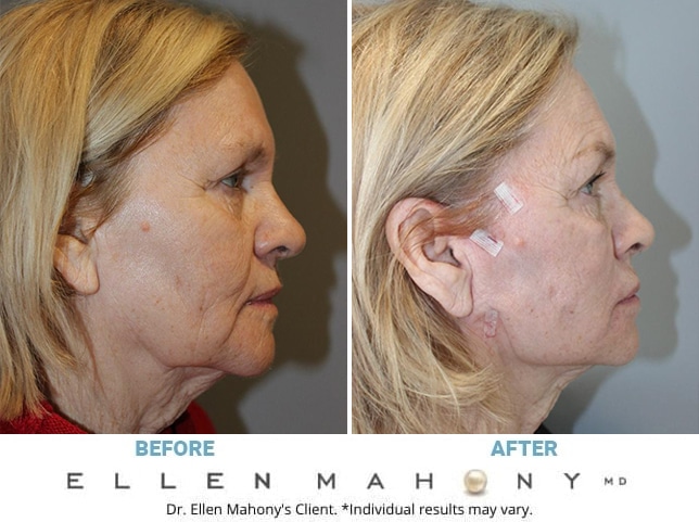 Before and After Image: Case #11998 - right-side