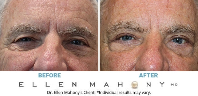 Before and After Image: Case #12387 - front