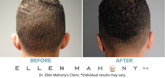 Before and After Image: Case #8017 - back