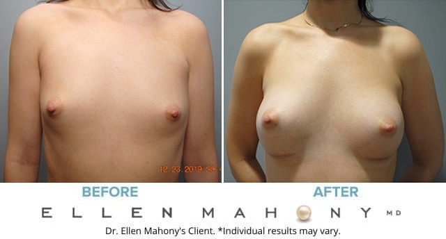 Before and After Image: Case #8560 - front