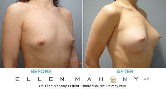 Before and After Image: Case #8560 - right-front-oblique