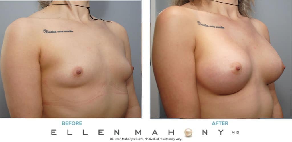 Before and After Image: Case # 8929 - right-front-oblique