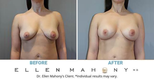 Before and After Image: Case #13216 - front