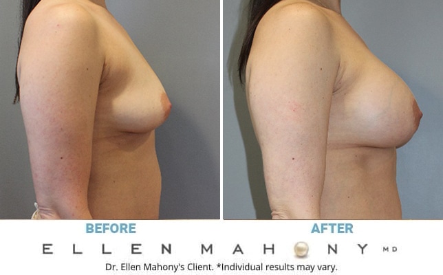 Before and After Image: Case #13216 - right-side