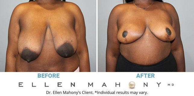 Before and After Image: Case #13043 - front