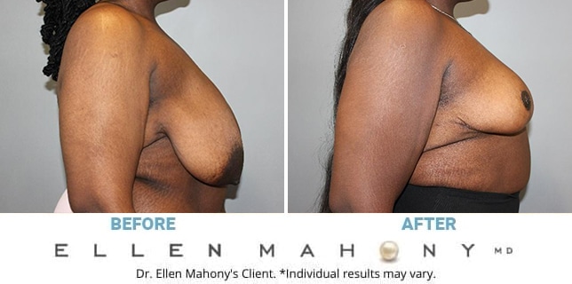 Before and After Image: Case #13043 - right-side