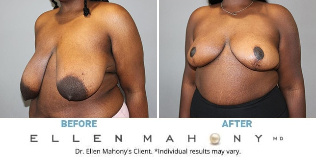 Before and After Image: Case #13043 - left-front-oblique