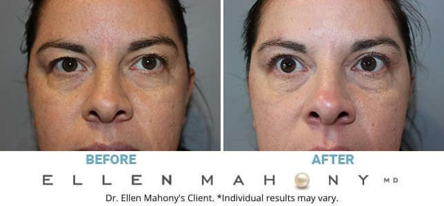 Before and After Image: Case #13215 - front