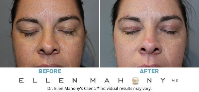Before and After Image: Case #13215 - front