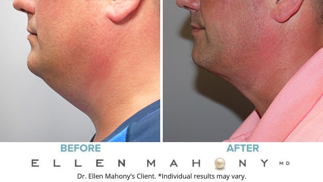 Before and After Image: Case #9098 - left-side