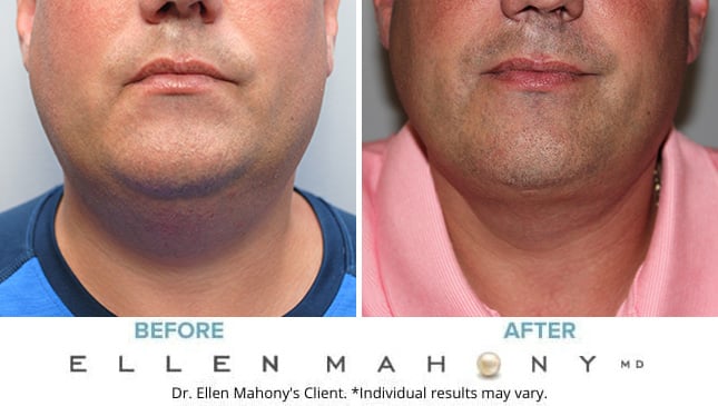 Before and After Image: Case #9098 - front