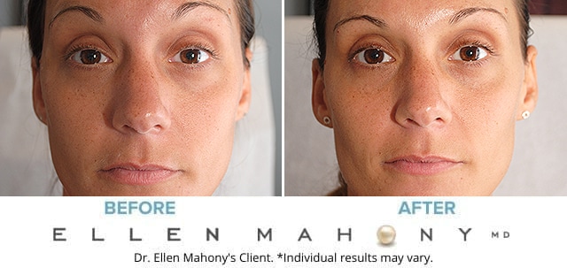 Before and After Image: Botox - front