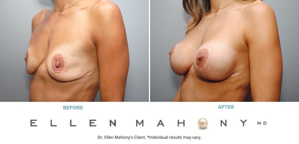 Before and After Image: Case #9124 - left-front-oblique