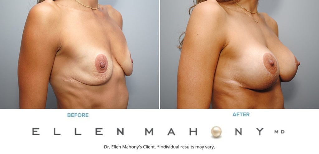 Before and After Image: Case #9124 - right-front-oblique