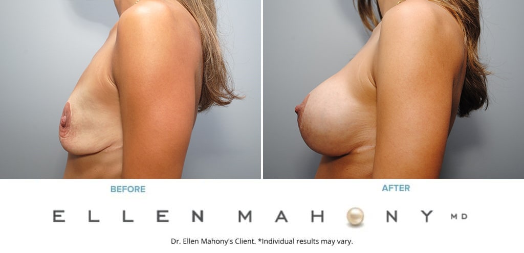 Before and After Image: Case #9124 - left-side