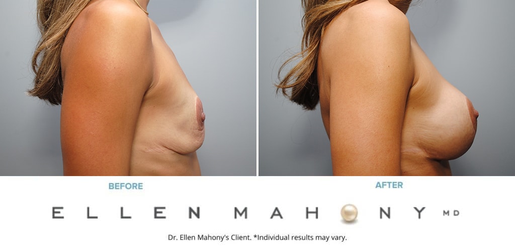 Before and After Image: Case #9124 - right-side