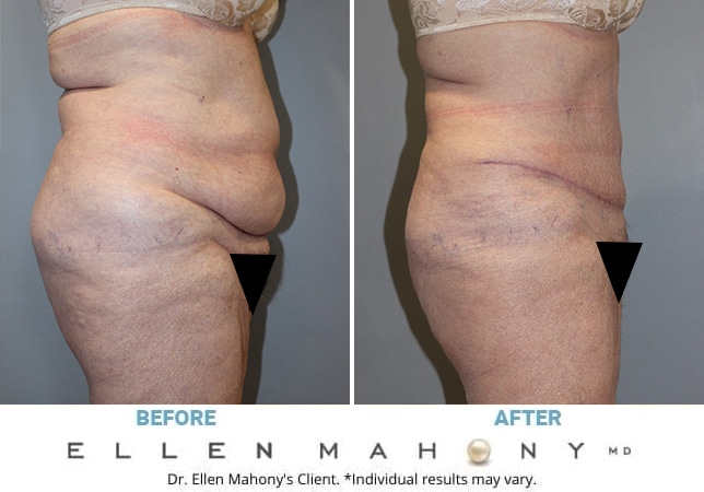 Before and After Image: Case #13053 - right-side