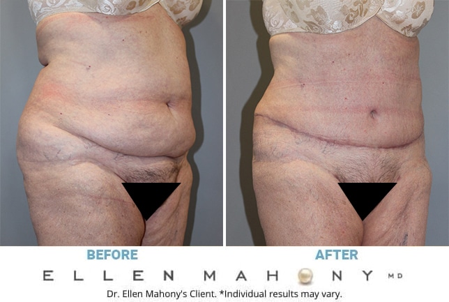 Before and After Image: Case #13053 - right-front-oblique
