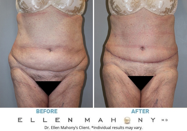 Before and After Image: Case #13053 - front