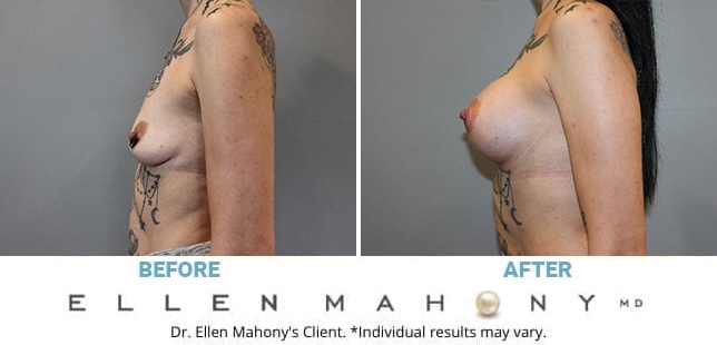 Before and After Image: Case #12899 - left-side