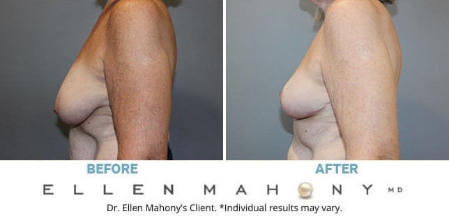 Before and After Image: Case #13066 - left-side