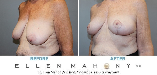 Before and After Image: Case #13066 - left-front-oblique