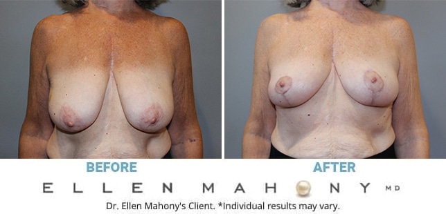 Before and After Image: Case #13066 - front