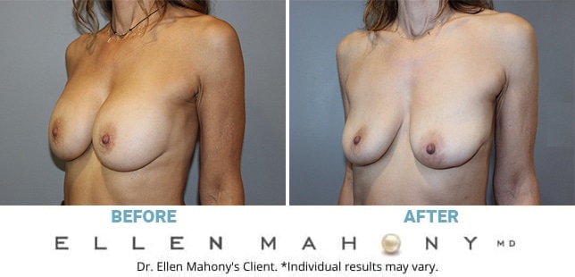 Before and After Image: Case #5039 - left-front-oblique