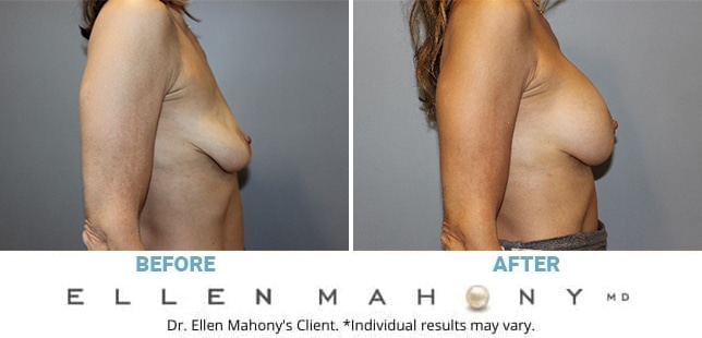 Before and After Image: Case #5039 - right-side