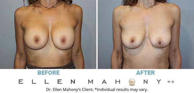 Before and After Image: Case #5039 - front