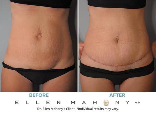 Before and After Image: Case #9144 - front