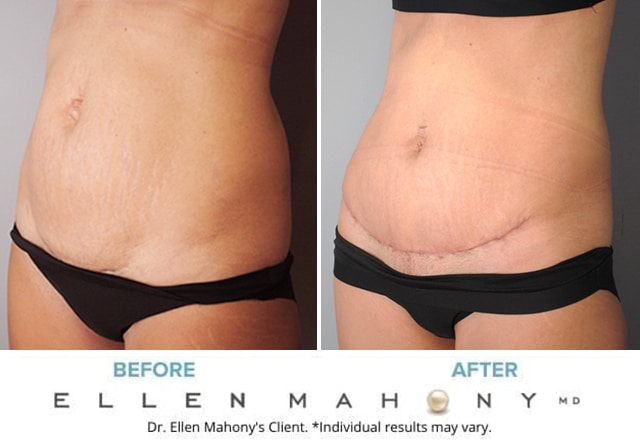 Before and After Image: Case #9144 - left-front-oblique