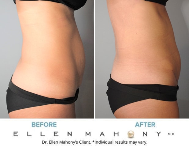 Before and After Image: Case #9144 - right-side