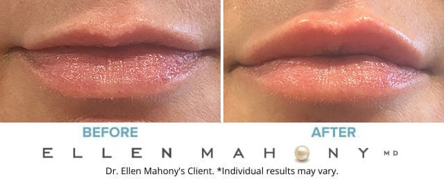 Before and After Image: Case #9290 - front