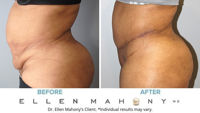 Before and After Image: Case #9967 - left-side