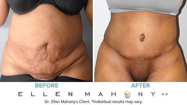 Before and After Image: Case #9967 - front