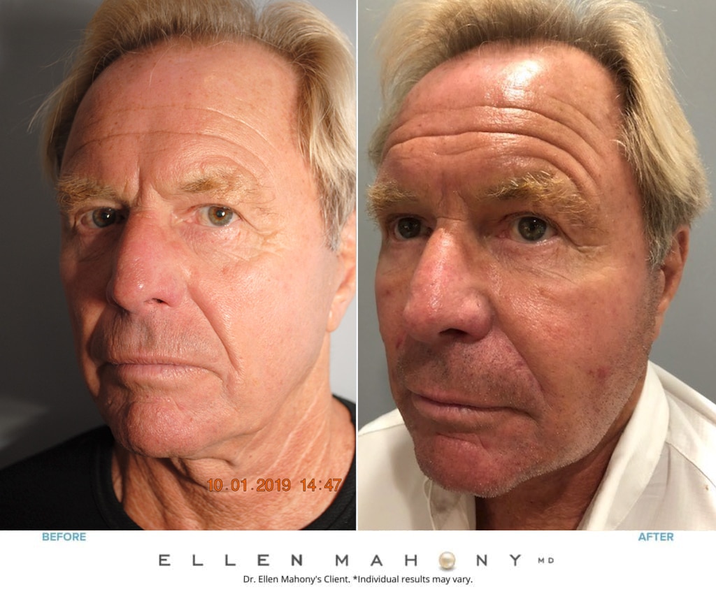 Before and After Image: Case #8461 - left-front-oblique