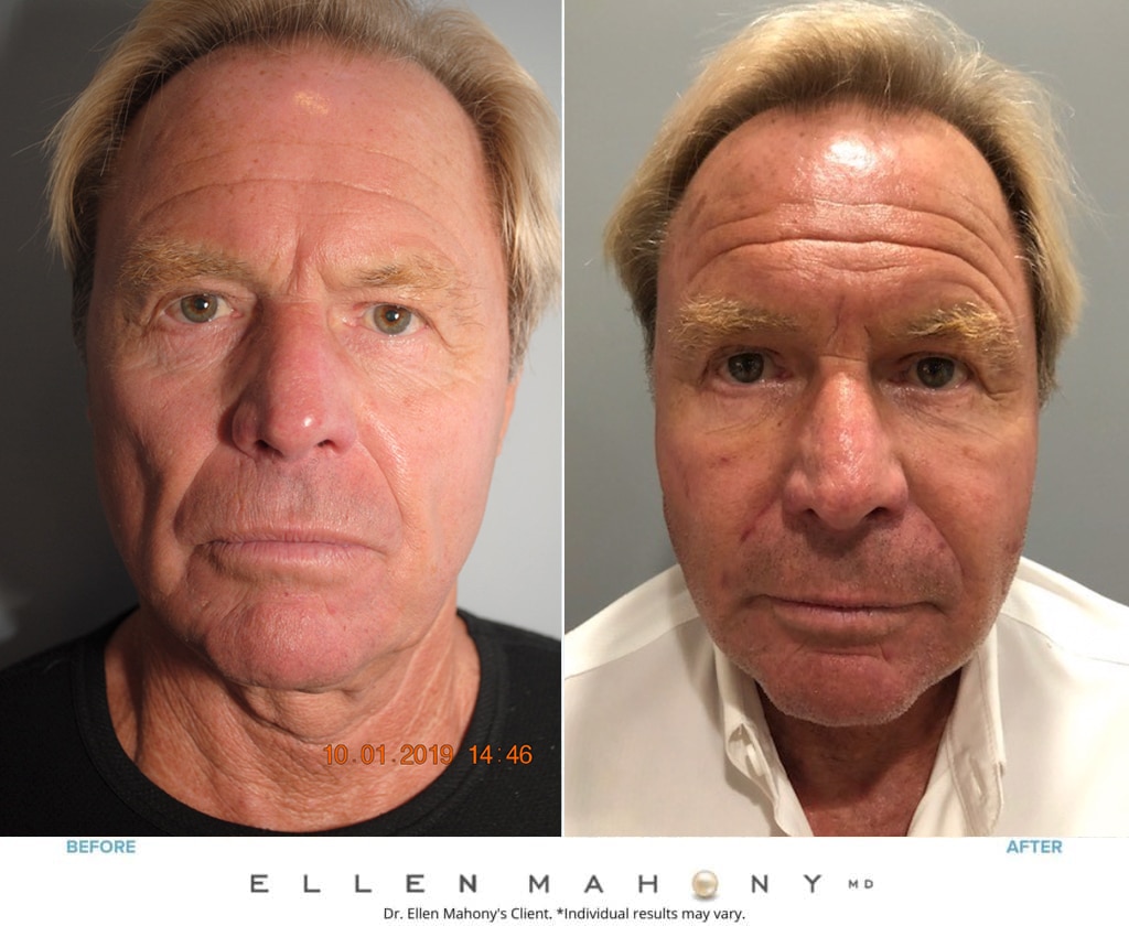 Before and After Image: Case #8461 - front