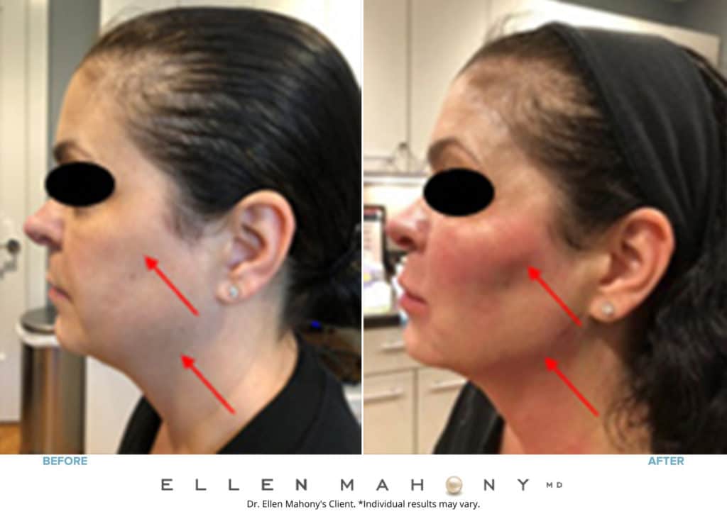 Before and After Image: Case #8356 - left-side